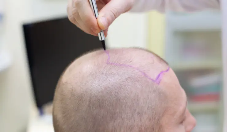 hair transplant cost in Bhubaneswar