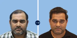 Results - Alloroots Hair Transplant Clinic - India's Best Hair Transplant Services