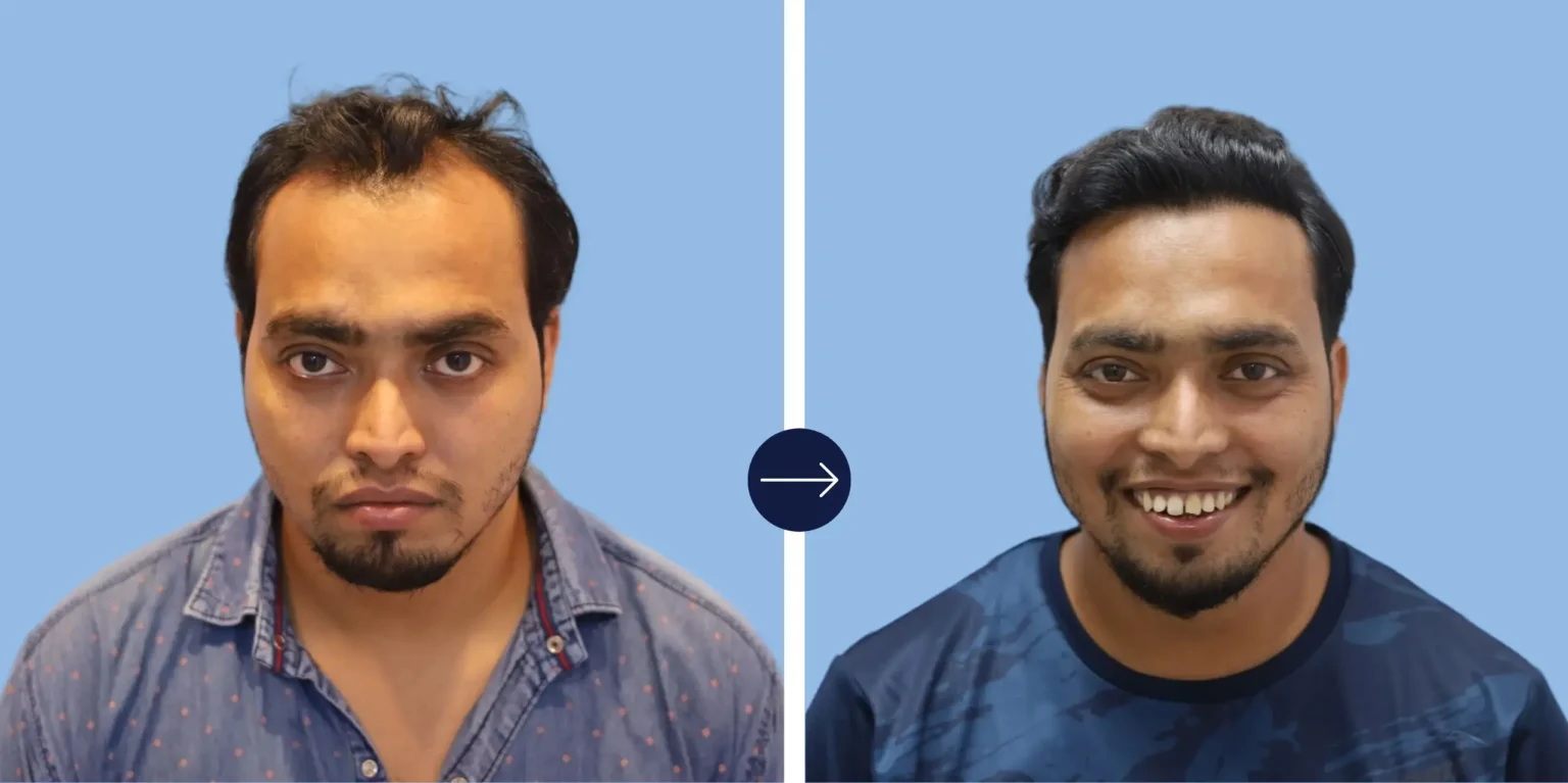 Hair transplant in delhi affordable & expert care hair transplant in delhi get topnotch care with expert surgeons advanced clinics and affordable prices Restore your hair and confidence in the capital city