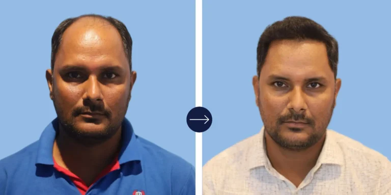 Results - Alloroots Hair Transplant Clinic - India's Best Hair Transplant Services