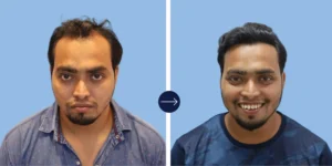 Results - Alloroots Hair Transplant Clinic - India's Best Hair Transplant Services