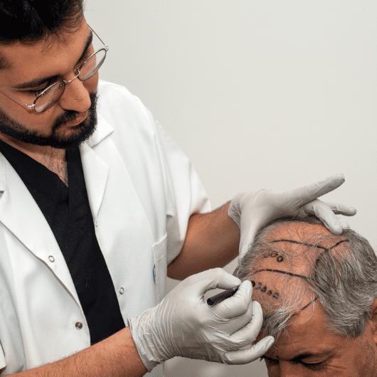 Our Hair Transplant Techniques