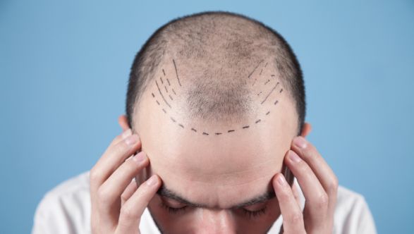 Hair Transplant