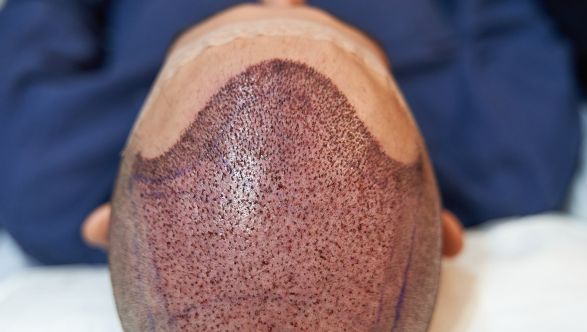 hair transplant