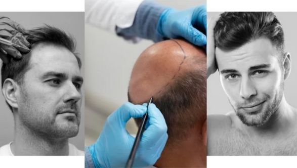 Types of hair transplant