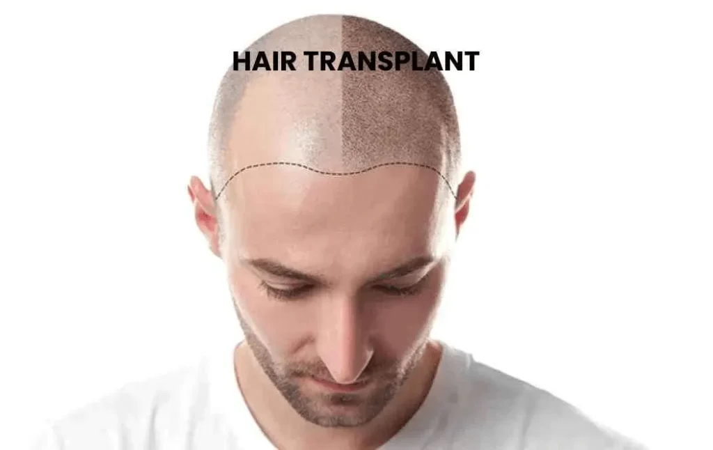 Get Hair Naturally with Alloroot – World’s Finest Hair Transplant Technique - Alloroots Hair Transplant Clinic - India's Best Hair Transplant Services