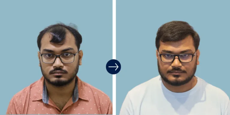 Hair Transplant in India - Alloroots Hair Transplant Clinic - India's Best Hair Transplant Services