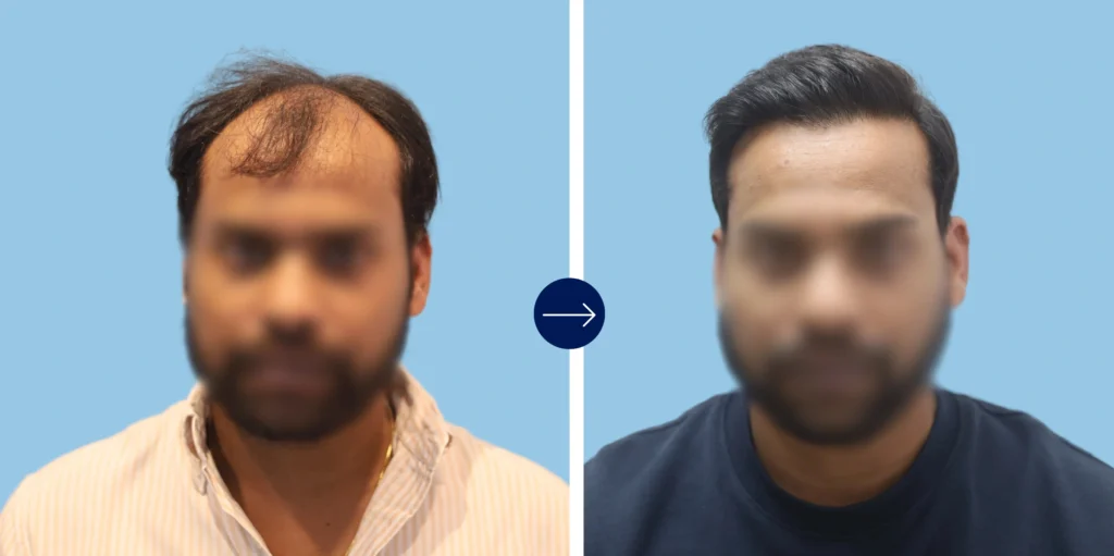 Results - Alloroots Hair Transplant Clinic - India's Best Hair Transplant Services