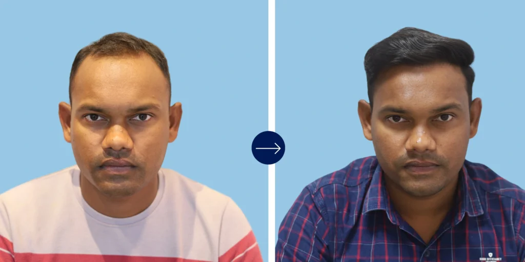 Results - Alloroots Hair Transplant Clinic - India's Best Hair Transplant Services