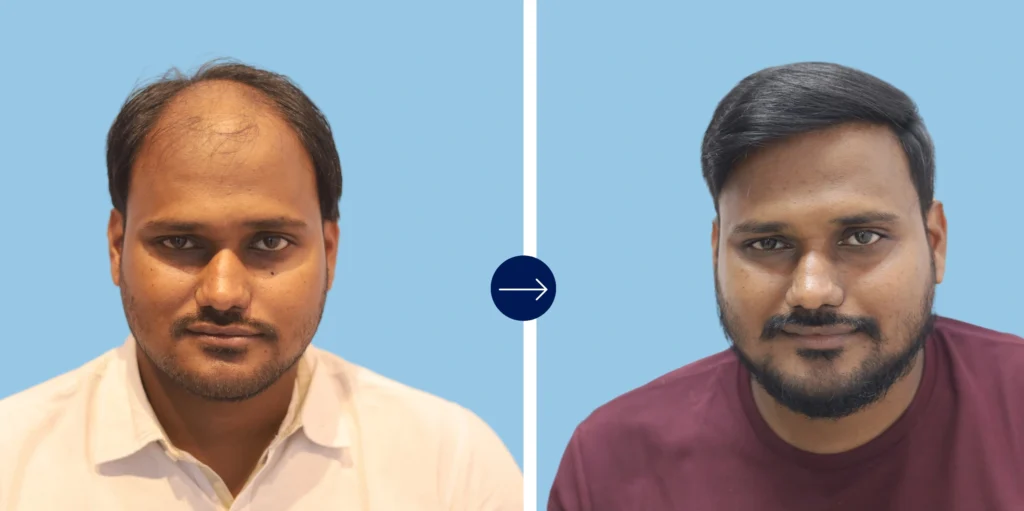 Results - Alloroots Hair Transplant Clinic - India's Best Hair Transplant Services