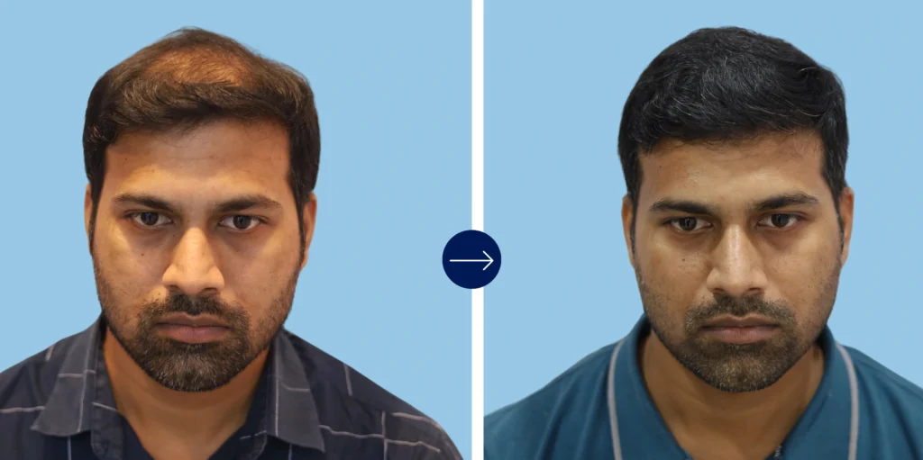 Results - Alloroots Hair Transplant Clinic - India's Best Hair Transplant Services