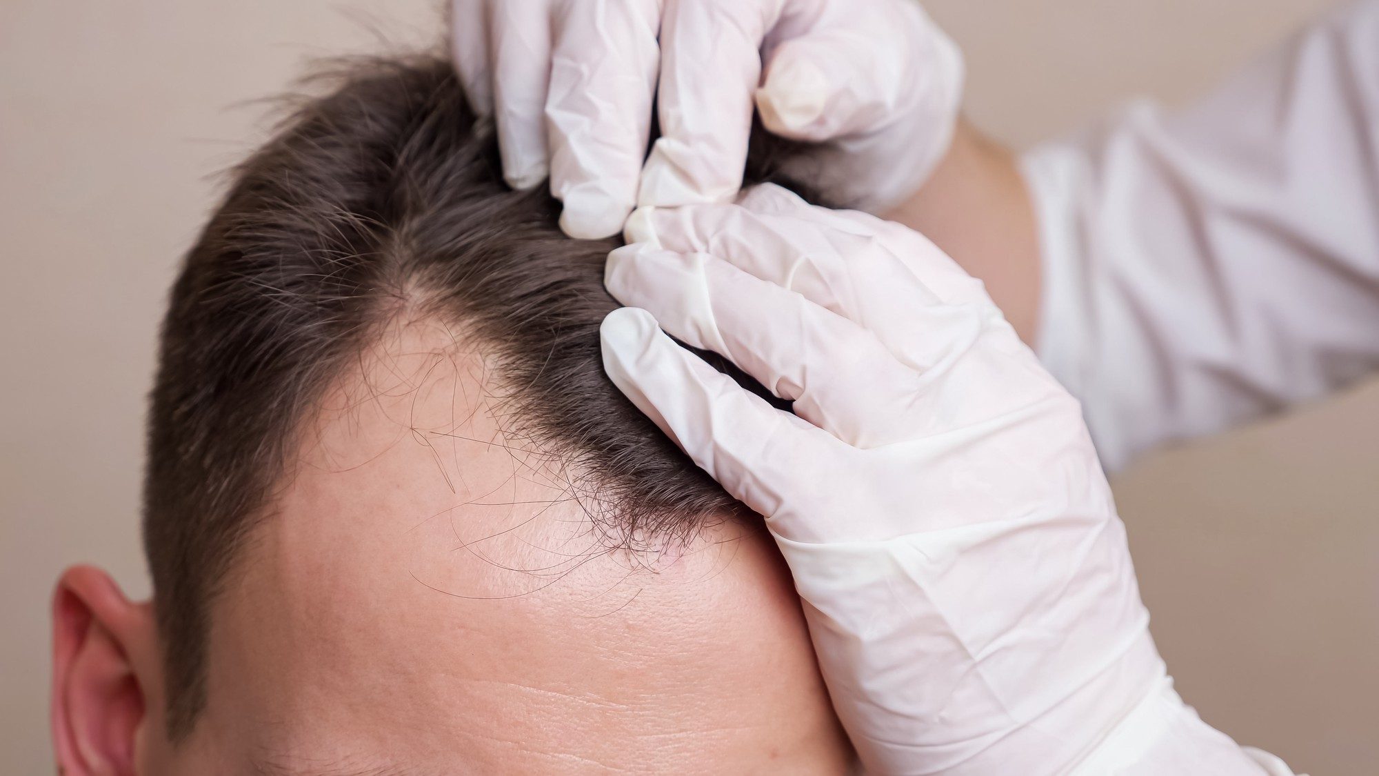 Causes of Hair Loss - Alloroots Hair Transplant Clinic - India's Best Hair Transplant Services