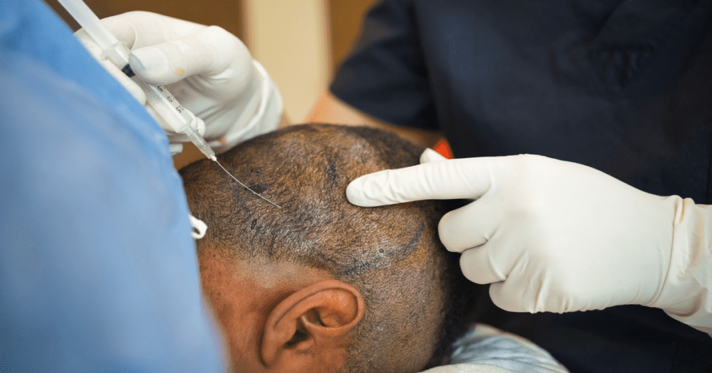 How to Prepare for a Hair Transplant