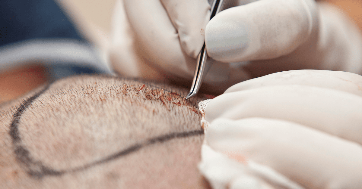 Which Country Is Best for Hair Transplant? A Comprehensive Guide to Why India Stands Out - Alloroots Hair Transplant Clinic - India's Best Hair Transplant Services