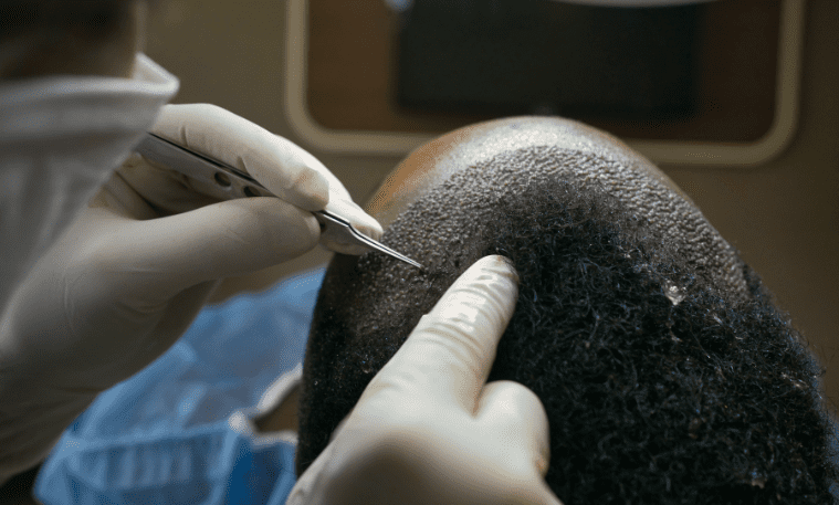 Male Pattern Baldness Treatment - Alloroots Hair Transplant Clinic - India's Best Hair Transplant Services