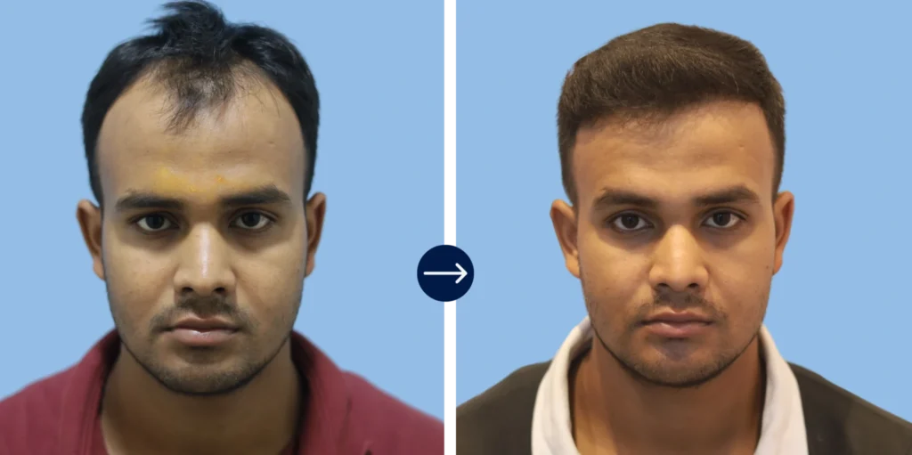 Best Hair Transplant in Bhubaneswar - Alloroots Hair Transplant Clinic - India's Best Hair Transplant Services