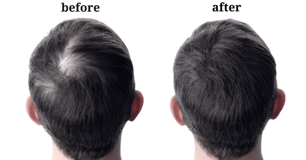 Hair Transplant Recovery: What to Expect After 1, 2, and 3 Months - Alloroots Hair Transplant Clinic - India's Best Hair Transplant Services