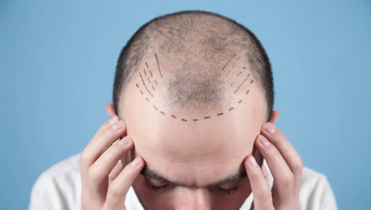 Is a hair transplant painful? - Alloroots Hair Transplant Clinic - India's Best Hair Transplant Services