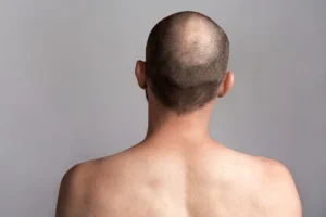 A Beginners Guide To Hair Transplants How It Works