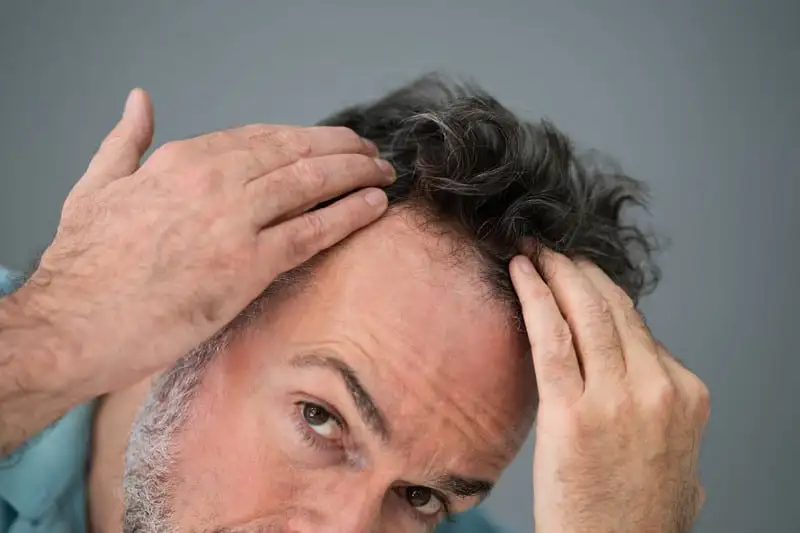 When can I touch my transplanted hair? 1 When can I touch my transplanted hair? - Alloroots Hair Transplant Clinic - India's Best Hair Transplant Services
