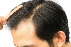 When is the best age for a hair transplant? 1 what makes you a good candidate for a hair transplant