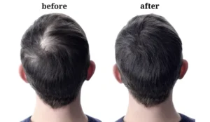 How to know if my hair transplant is successful? 1 draloksahoo blogs 1