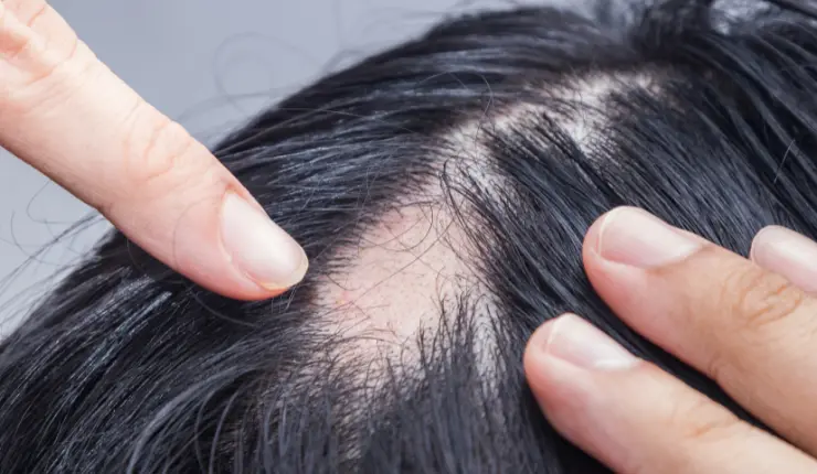 What are the treatment options for alopecia areata? 7 What are the treatment options for alopecia areata? - Alloroots Hair Transplant Clinic - India's Best Hair Transplant Services