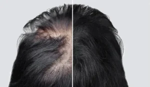 Hair transplant in Scarring Alopecia - Alloroots Hair Transplant Clinic - India's Best Hair Transplant Services