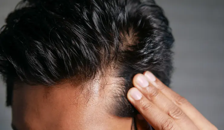 How long does the pain last after a hair transplant? - Alloroots Hair Transplant Clinic - India's Best Hair Transplant Services