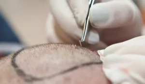 Are Hair Transplant Scars Permanent? - Alloroots Hair Transplant Clinic - India's Best Hair Transplant Services