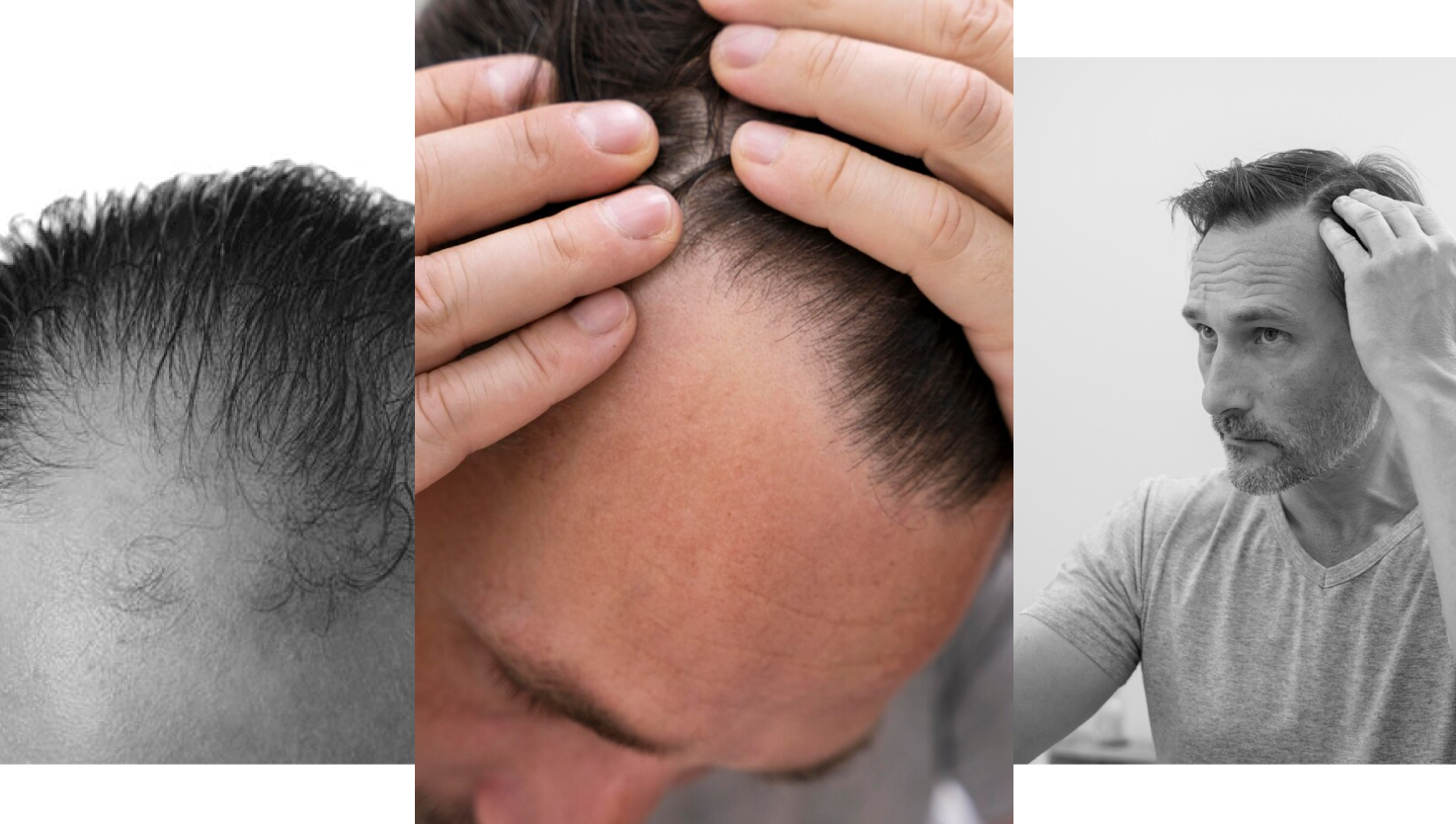 Male Hair loss old 3 Male Hair loss old - Alloroots Hair Transplant Clinic - India's Best Hair Transplant Services
