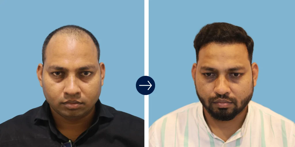 Results - Alloroots Hair Transplant Clinic - India's Best Hair Transplant Services
