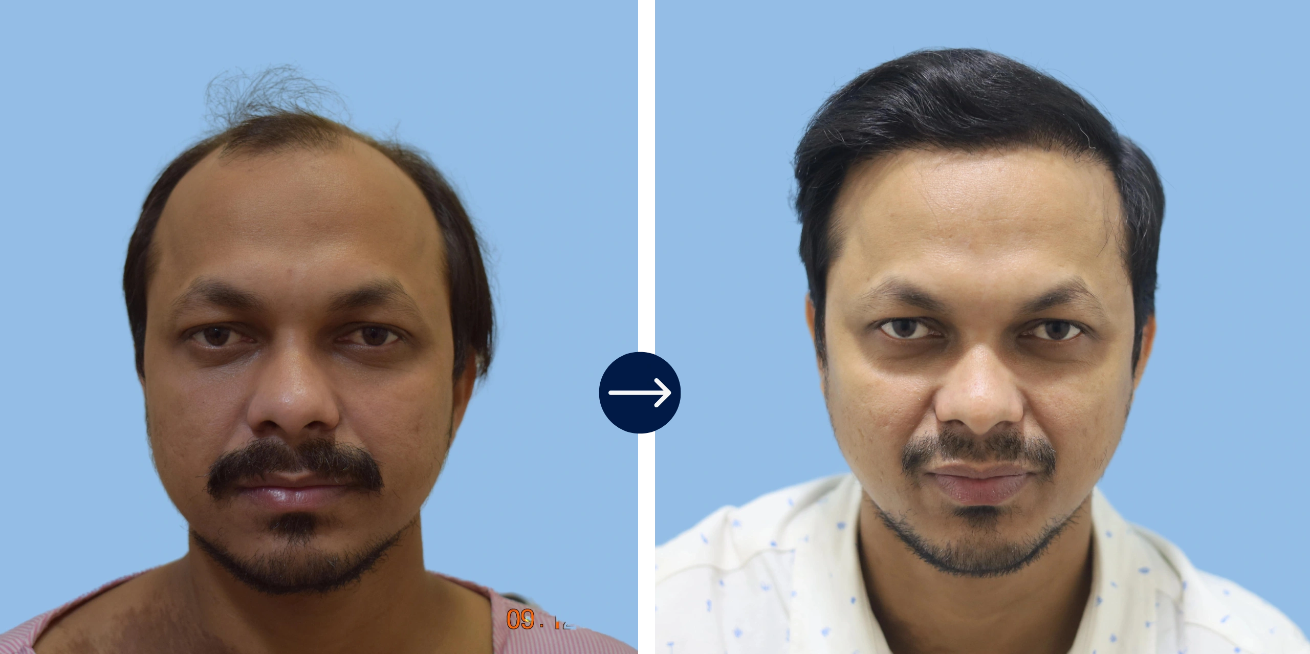 Cost of Hair Transplant in India - Alloroots 1 Results - Alloroots Hair Transplant Clinic - India's Best Hair Transplant Services