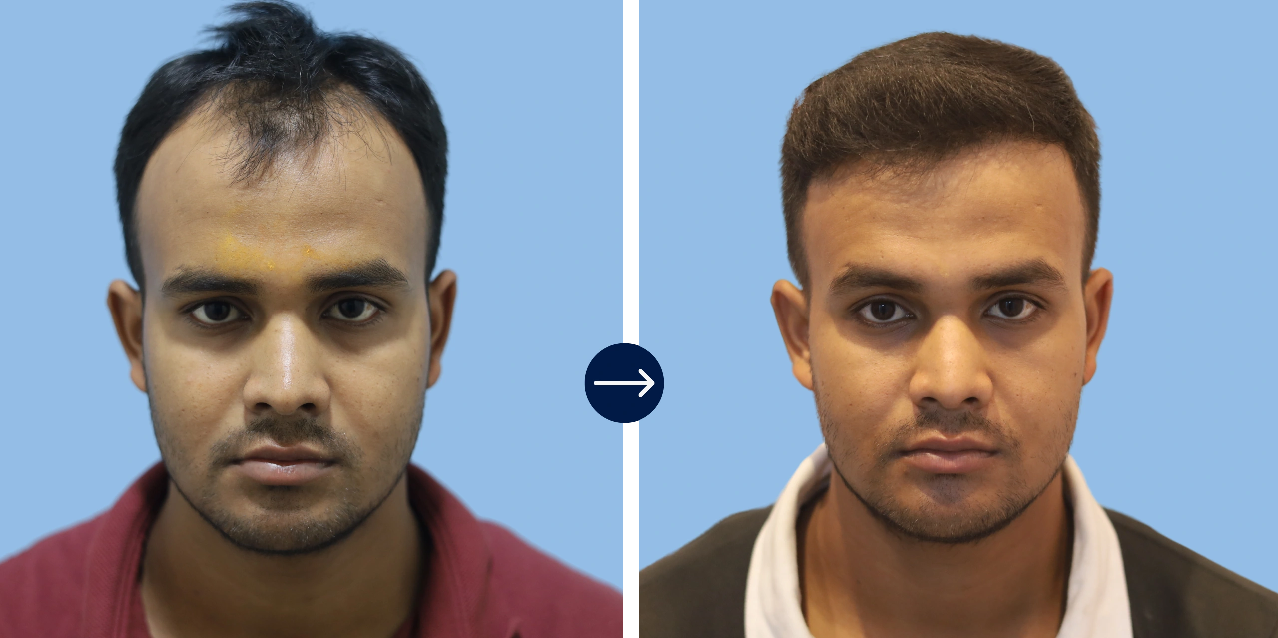 Results - Alloroots Hair Transplant Clinic - India's Best Hair Transplant Services