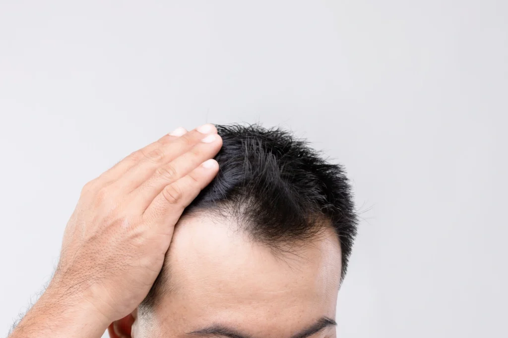 Can Transplanted Hair Fall Out? Understanding Hair Transplantation - Alloroots Hair Transplant Clinic - India's Best Hair Transplant Services