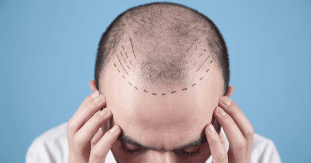 Does Hair Transplant Have Side Effects 13 Does Hair Transplant Have Side Effects - Alloroots Hair Transplant Clinic - India's Best Hair Transplant Services