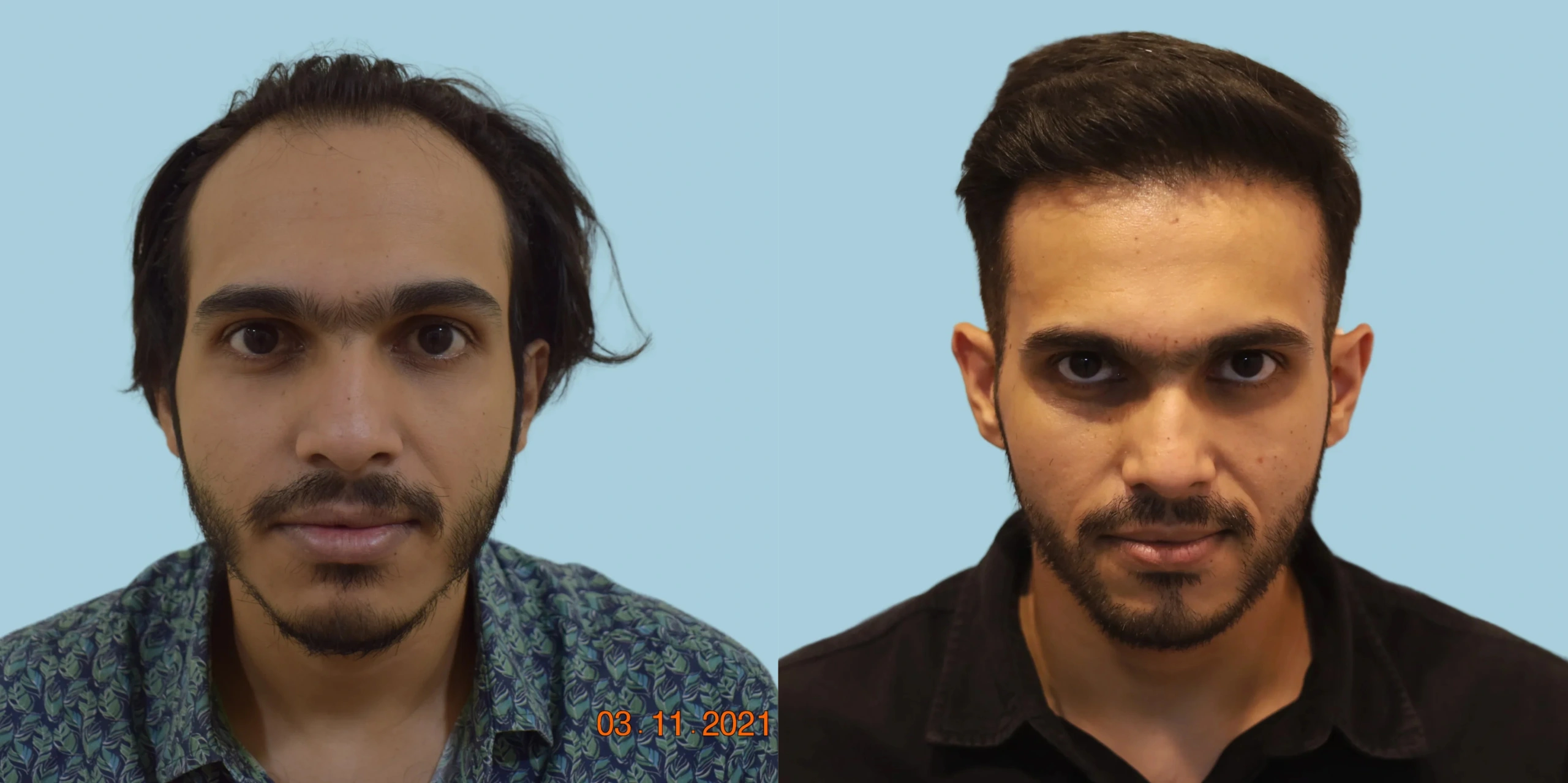 Best hair transplant result alloroots