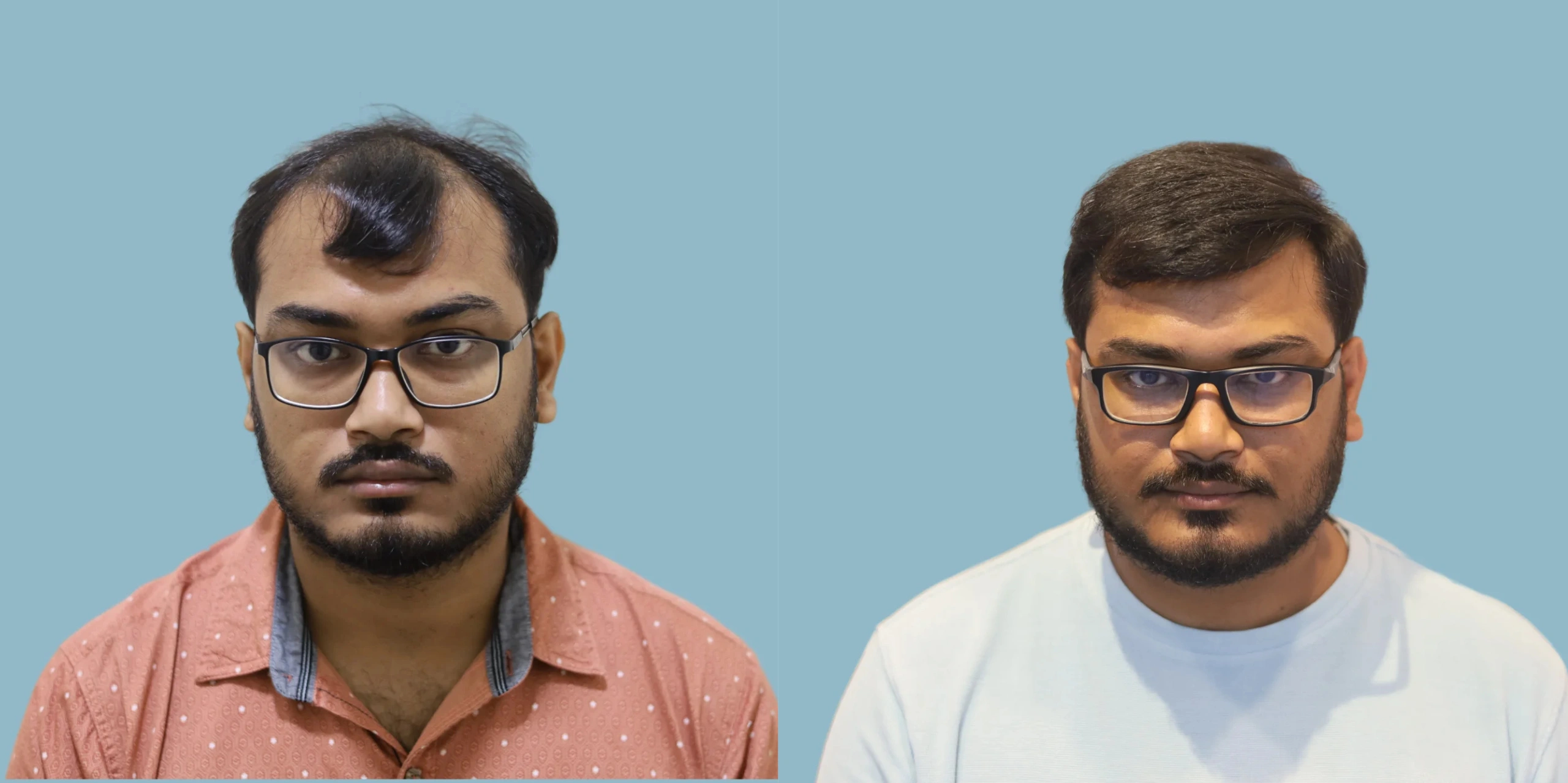 Best hair transplant result alloroots