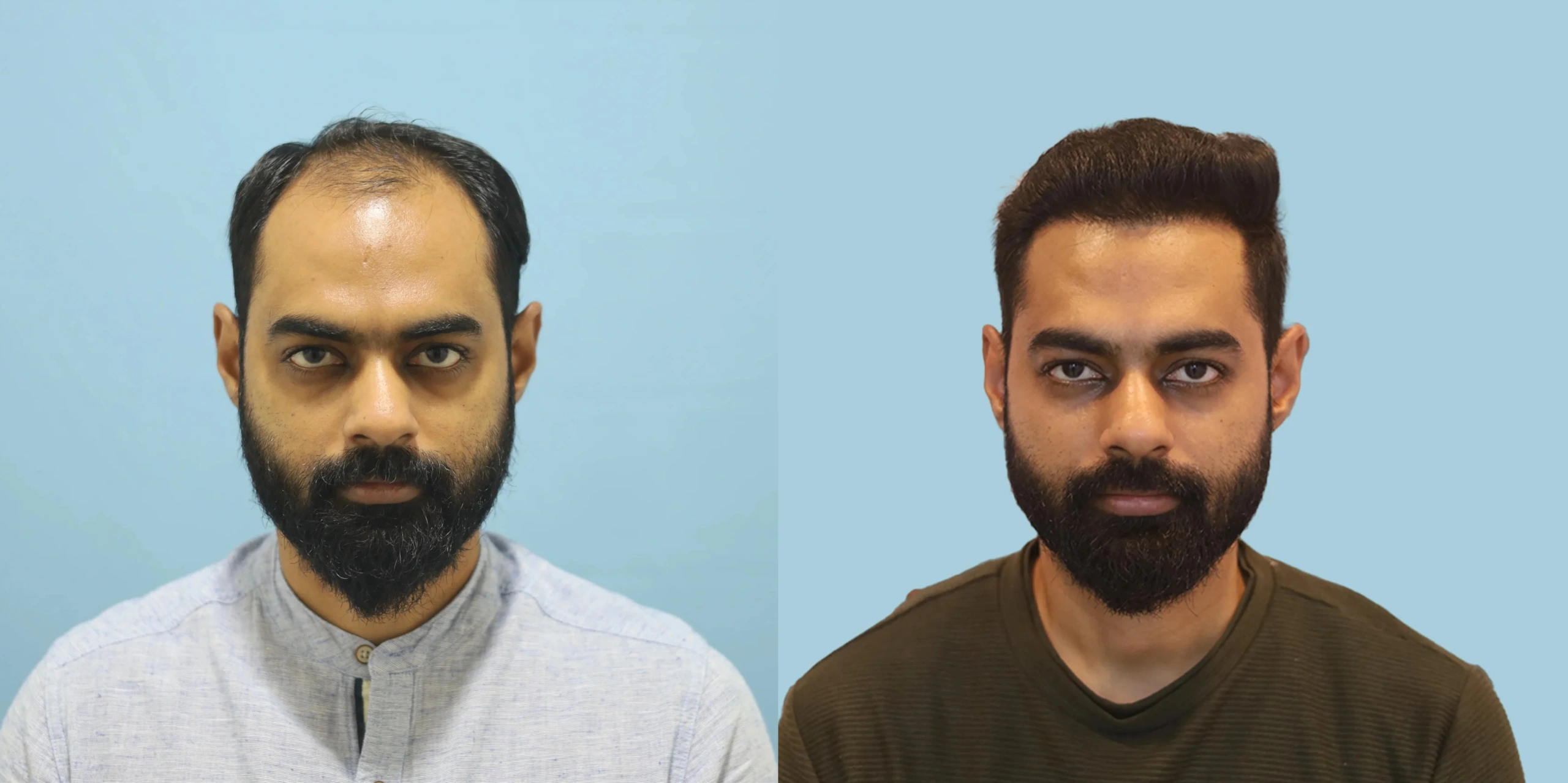 Best hair transplant result alloroots