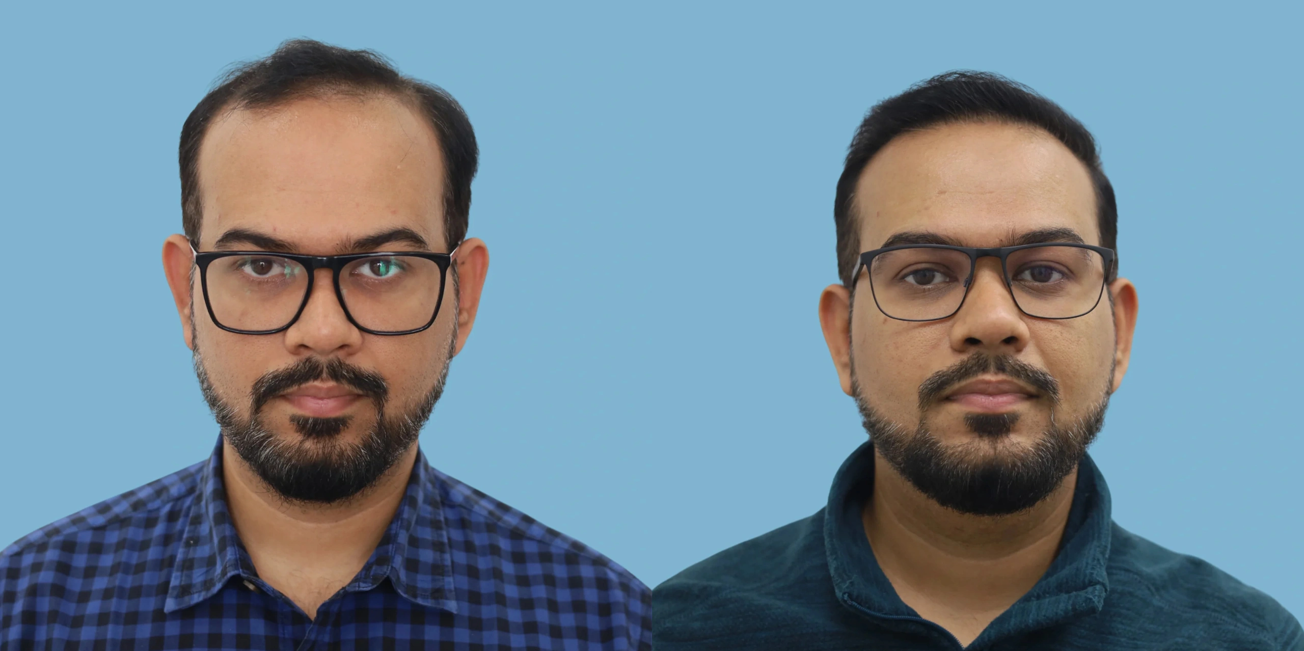 Best hair transplant result alloroots