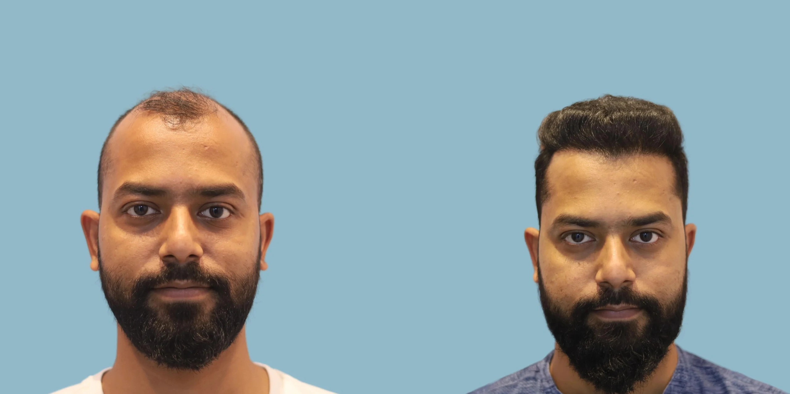 Best hair transplant result alloroots