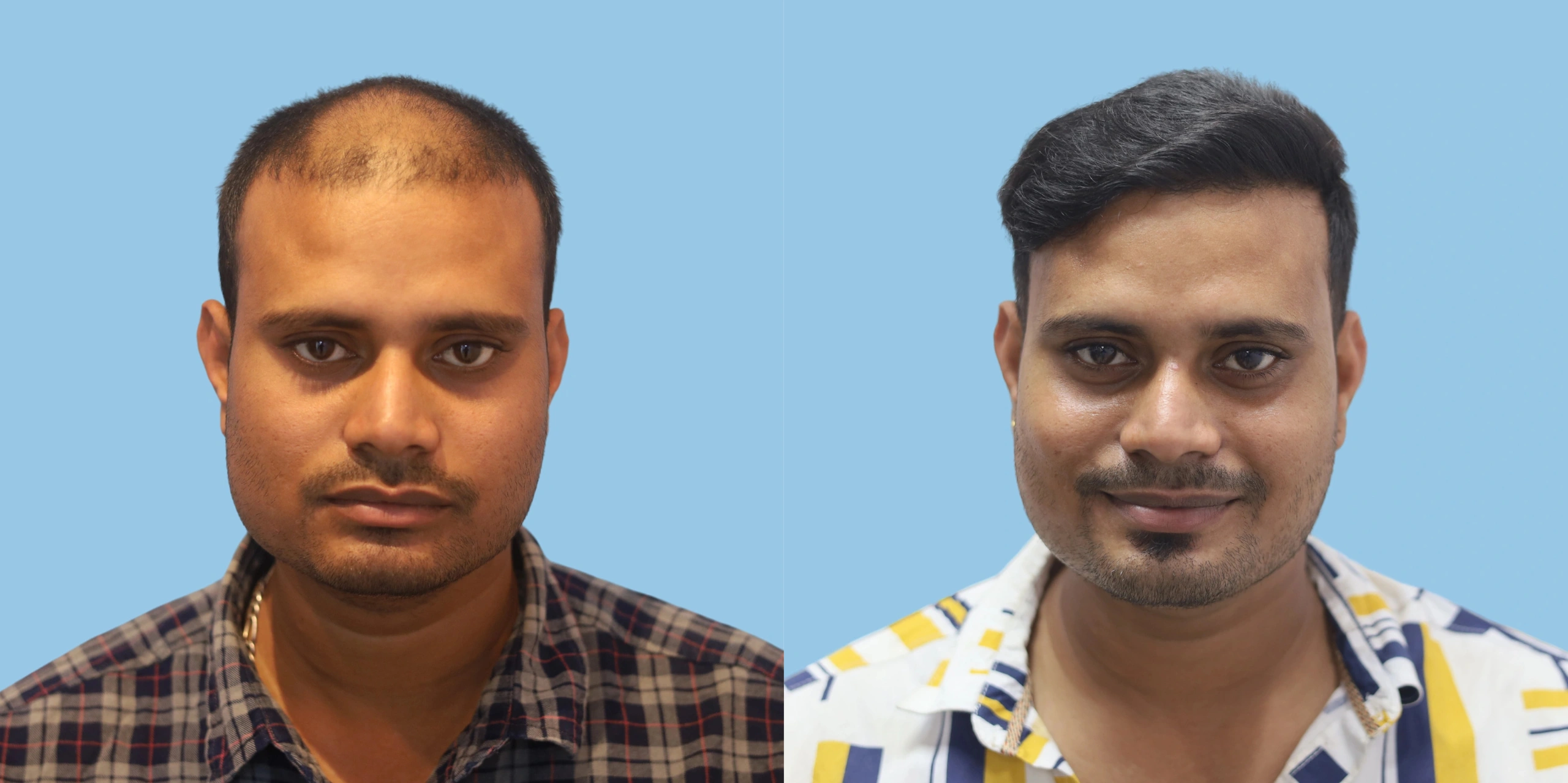 Best hair transplant result alloroots