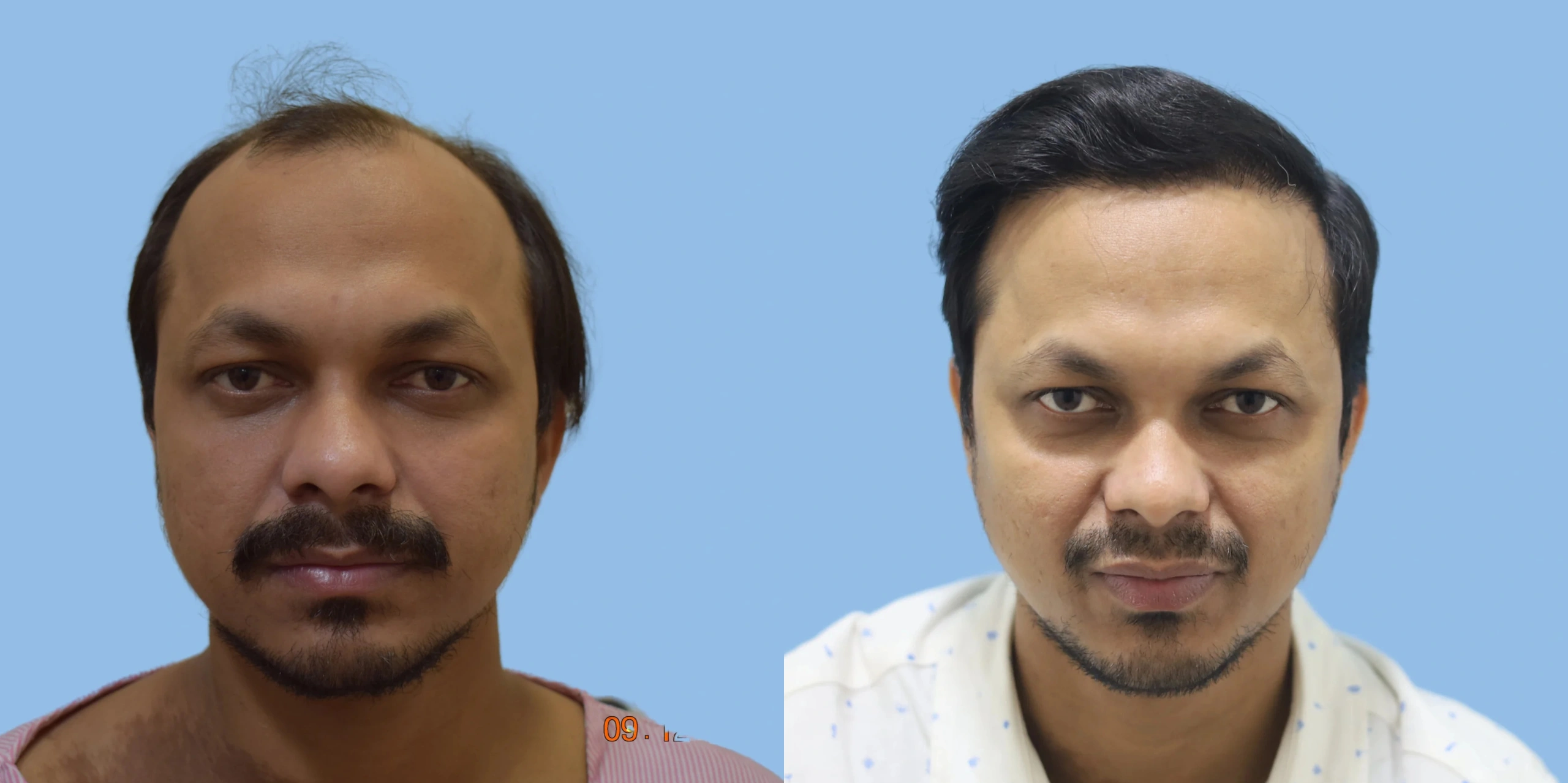 Best hair transplant result alloroots