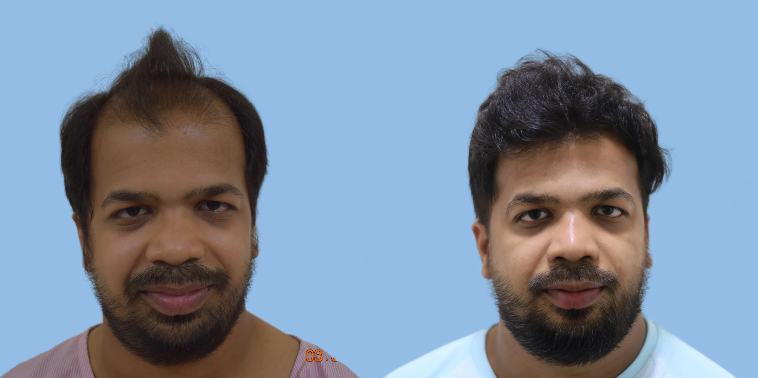 Best hair transplant result alloroots