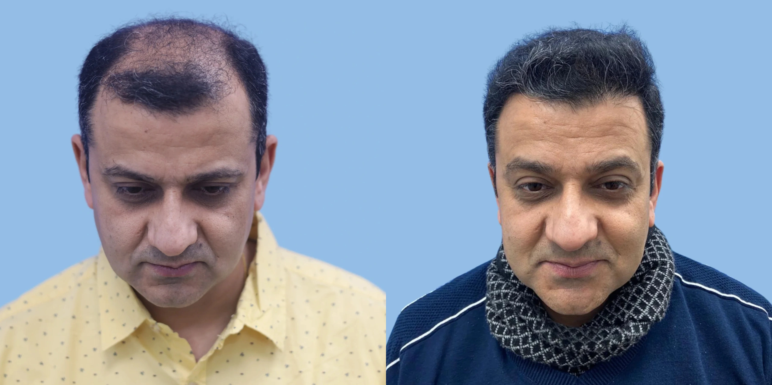 Best hair transplant result alloroots