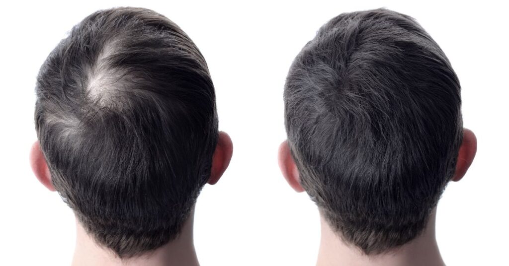 Donor Area After Hair Transplant: Care, Recovery, and What to Expect 3 Donor Area After Hair Transplant: Care, Recovery, and What to Expect - Alloroots Hair Transplant Clinic - India's Best Hair Transplant Services