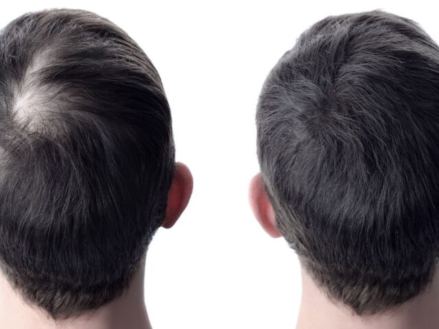 Donor Area After Hair Transplant: Care, Recovery, and What to Expect
