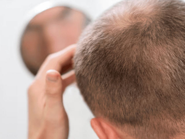 1 Graft How Many Hair: Understanding Hair Transplants with Alloroots