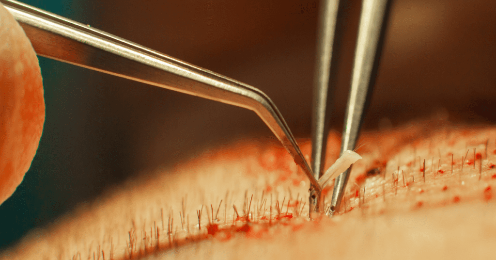 Hair Transplant Cost in Dehradun: A Complete Guide by Alloroots 11 Hair Transplant Cost in Dehradun: A Complete Guide by Alloroots - Alloroots Hair Transplant Clinic - India's Best Hair Transplant Services