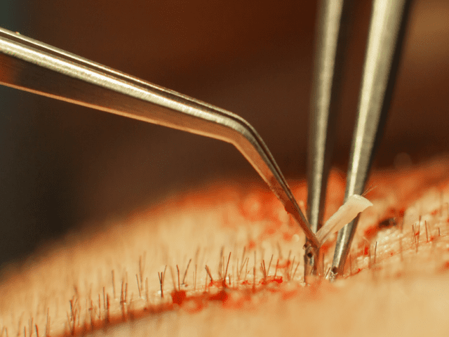 Hair Transplant Cost in Dehradun: A Complete Guide by Alloroots